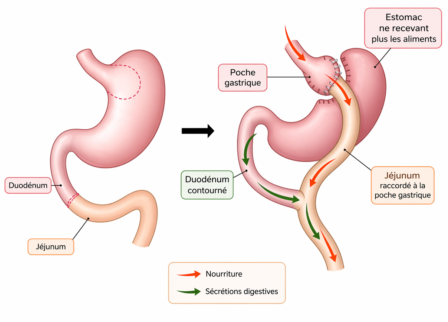 Bypass gastrique diététicienne Bouaye Nantes
